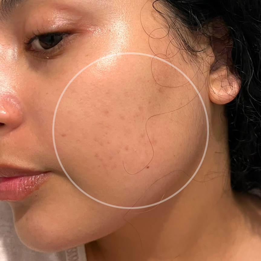 Pele com acne antes e depois do uso do Sérum Ultra 20 (resultado individual)
