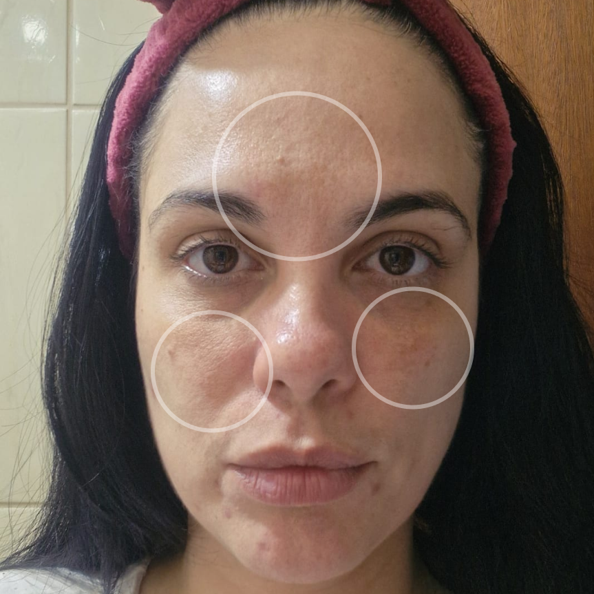 Pele com manchas antes e depois do uso do Sérum Ultra 20 (resultado individual)